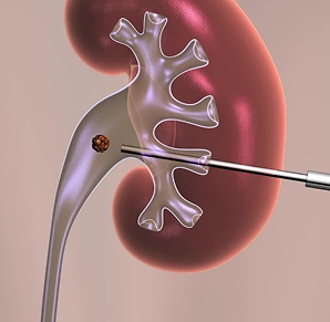 PCNL Surgery