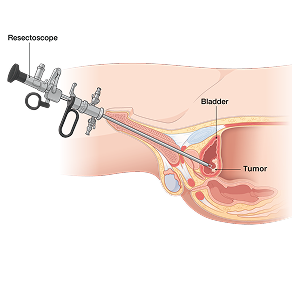 TURBT Surgery